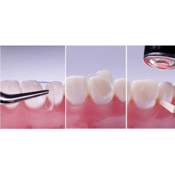 Dental Transparent Strip Crowns Posterior