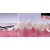 Dental Transparent Strip Crowns Posterior