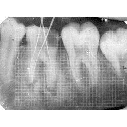 Dental Xray Measuring Grid