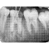 Dental Xray Measuring Grid