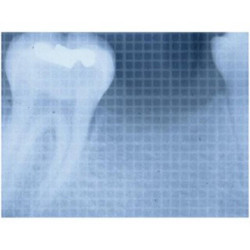 Dental Xray Measuring Grid