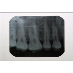 Dental Xray Measuring Grid