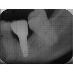 Dental Xray Measuring Grid