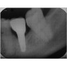 Dental Xray Measuring Grid