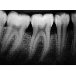 Dental Xray Measuring Grid