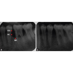 Dental Xray Measuring Grid