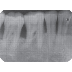 Dental Xray Measuring Grid