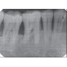 Dental Xray Measuring Grid