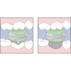 Dental Crown & Inlay Setter