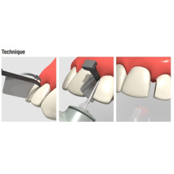 Directa FenderWedge Prep Dental Wedge & Per piece