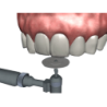 The Tooth- Patient Consultation / Education software - Digital