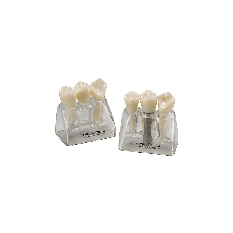 Implant Tooth Model 3000