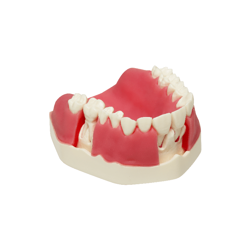 Model with double layered gingiva, sinus lift with Schneiderian membrane and buccal defect in first molar