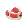 Model with double layered gingiva, sinus lift with Schneiderian membrane and buccal defect in first molar