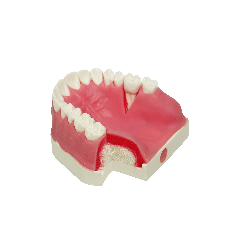 Model with double layered gingiva, sinus lift with Schneiderian membrane and buccal defect in first molar