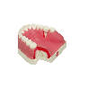 Model with double layered gingiva, sinus lift with Schneiderian membrane and buccal defect in first molar