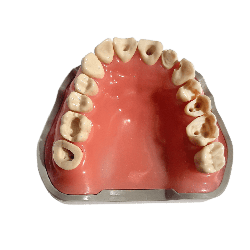 Prepared Teeth for Buildups and Post-and-Core Restorations (Upper) Prosthetic Dental Model
