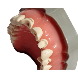 Prepared Teeth for Buildups and Post-and-Core Restorations (Upper) Prosthetic Dental Model