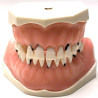 Parodonthology Jaw with diffusely carious teeth
