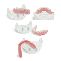Dental model for Overdenture with Implants