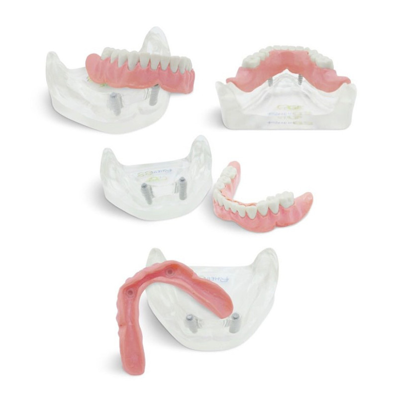 Dental model for Overdenture with Implants
