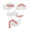 Dental model for Overdenture with Implants