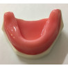 Spongy Bone Implant mandible with gums