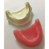 Spongy Bone Implant mandible with gums