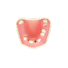 Post Extraction Immediate Implant Model