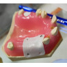 Post Extraction Immediate Implant Model