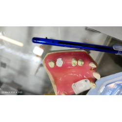 Post Extraction Immediate Implant Model