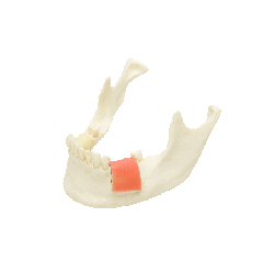 Model for implant placement for replaceable bone blocks of different bone density & Partially edentulous dental model for implan