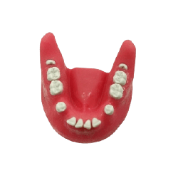 Impacted tooth Extraction Surgery Dental Jaw Model Upper and Lower set