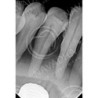 Dental Vice pair for Extracted Tooth & Magnetic or Screw in type Vice Pair