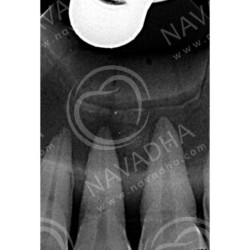 Dental Vice pair for Extracted Tooth & Magnetic or Screw in type Vice Pair