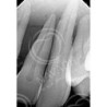 Dental Vice pair for Extracted Tooth & Magnetic or Screw in type Vice Pair