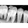 Dental Vice pair for Extracted Tooth & Magnetic or Screw in type Vice Pair