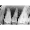 Dental Vice pair for Extracted Tooth & Magnetic or Screw in type Vice Pair