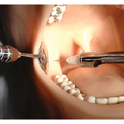 Oral Anaesthesia Training Manikin, Anesthesia