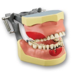 Articulated periodontia Dentoform with inflammation