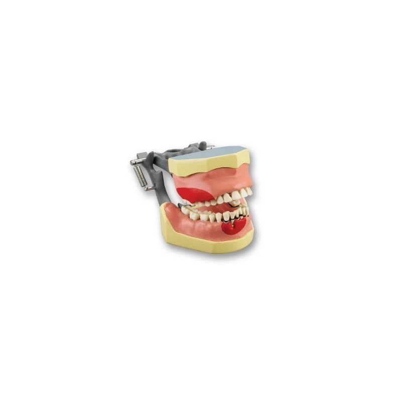Articulated periodontia Dentoform with inflammation