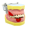 Articulated periodontia Dentoform with inflammation