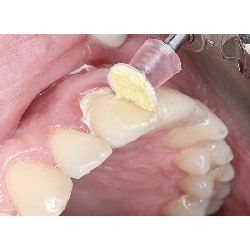 Shofu Dental SuperSnap - Super Buff Set