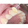 Shofu Dental SuperSnap - Super Buff Set