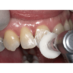 Shofu Dental SuperSnap - Super Buff Set