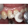 Shofu Dental SuperSnap - Super Buff Set