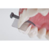 Directa FenderWedge Prep Dental Wedge & 36 pcs pack