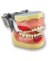 Articulated periodontia Dentoform with inflammation
