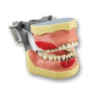 Articulated periodontia Dentoform with inflammation
