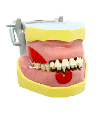 Articulated periodontia Dentoform with inflammation